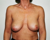 Feel Beautiful - Breast Revision San Diego 18 - After Photo